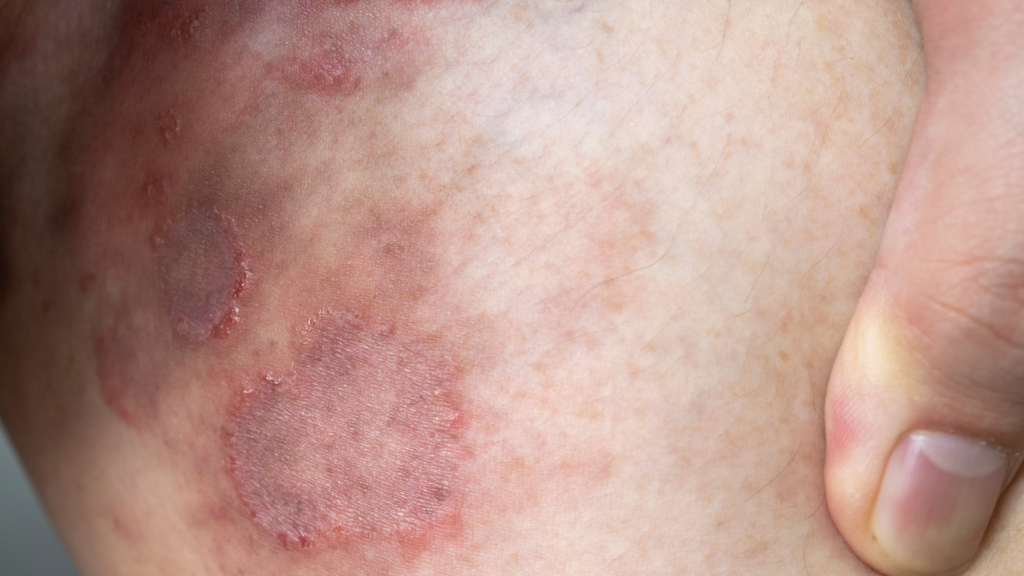 Tinea | Dra. Letícia Fachinelli