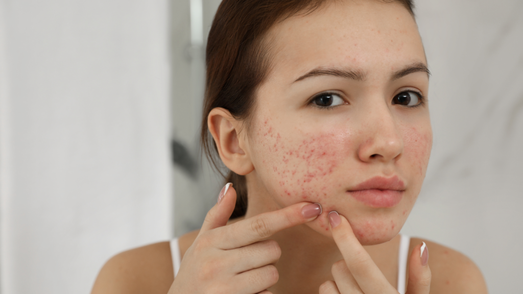 Acne Vulgar | Dra. Letícia Fachinelli