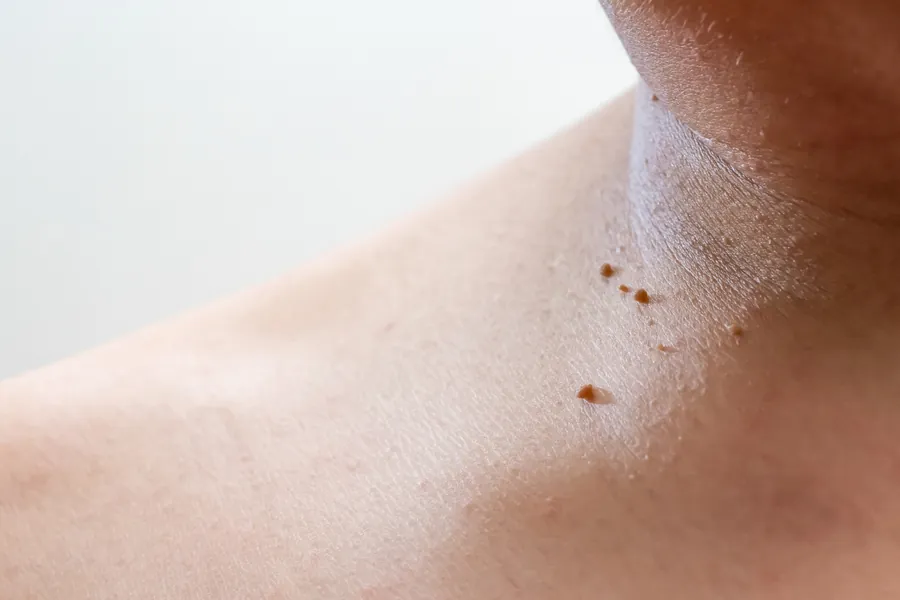 Acrocórdons: O que São, Causas e 4 Formas de Remover Fibromas Moles