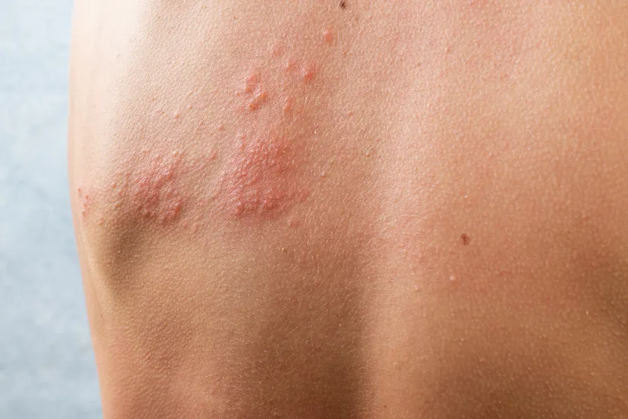 Herpes Zoster: 4 Complicações, Sintomas e Tratamento Dermatológico