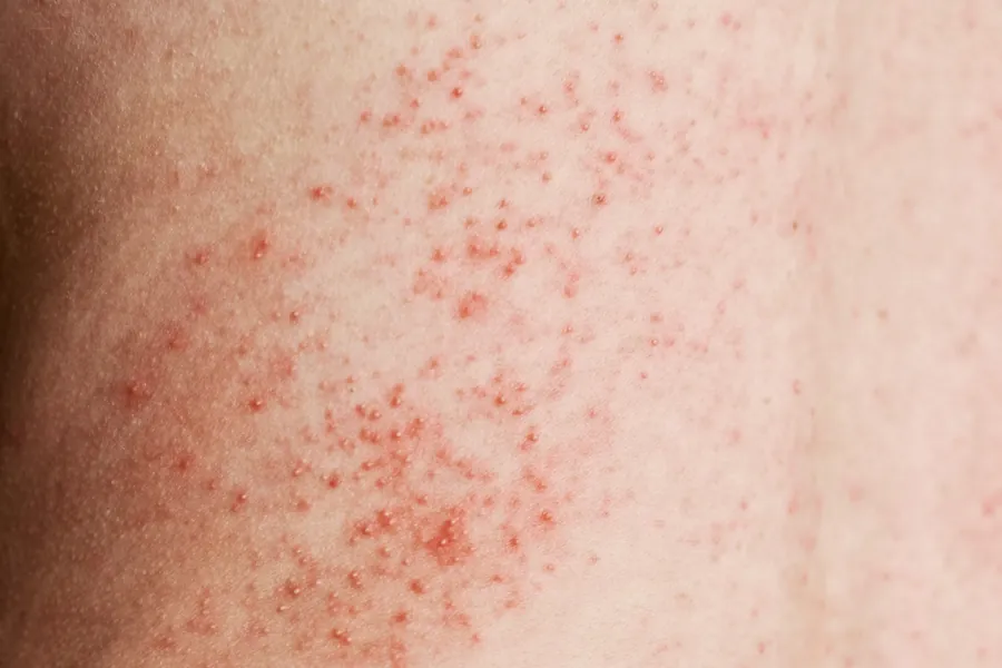 Miliária Brotoeja: Causas, 4 Tipos e Tratamentos Dermatológicos