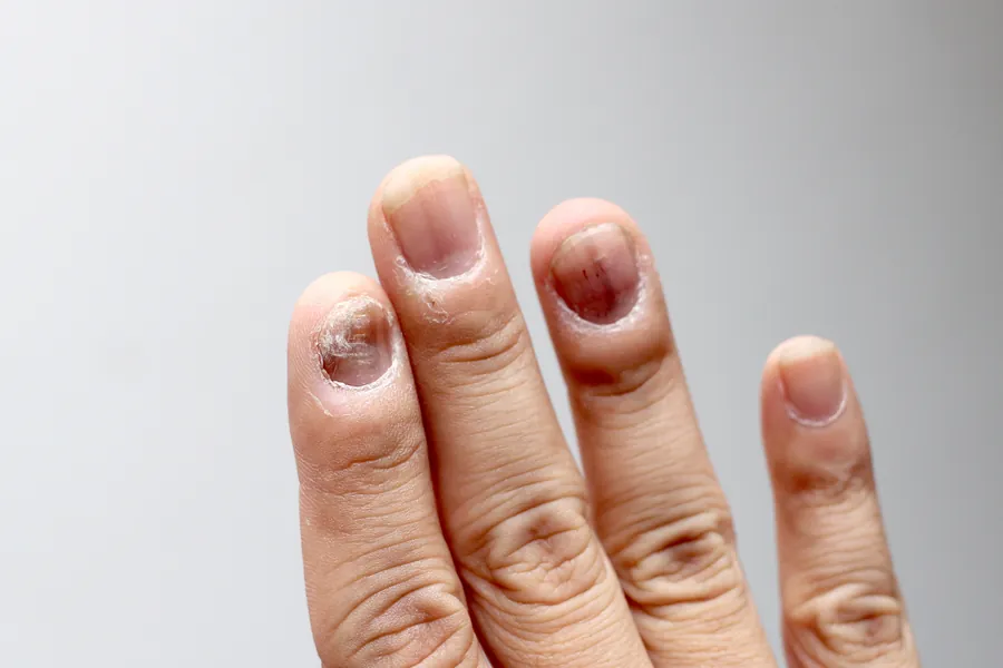 Onicomicose: Causas, Sintomas e 5 Tratamentos para Micose nas Unhas