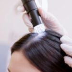 Intradermoterapia Capilar | Dra. Letícia Fachinelli