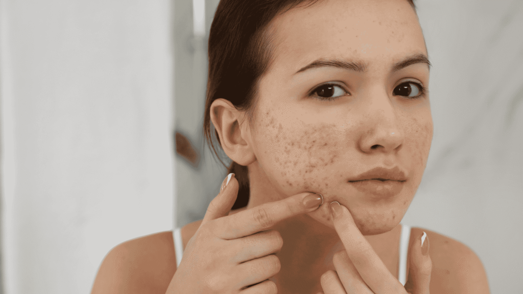 Acne na Vida Adulta | Dra. Letícia Fachinelli