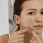 Acne na Vida Adulta | Dra. Letícia Fachinelli