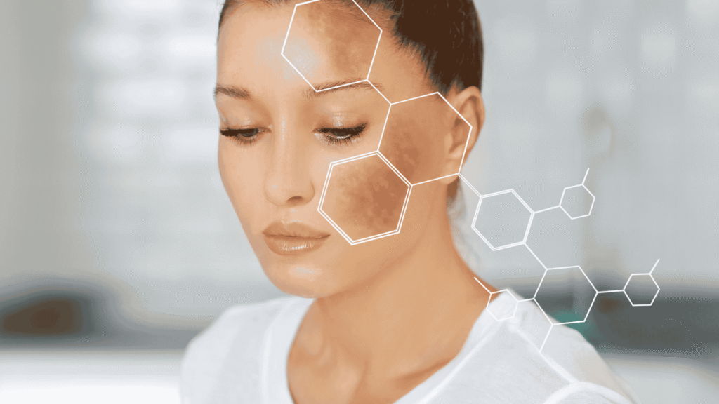 Melasma | Dra. Letícia Fachinelli