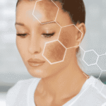 Melasma | Dra. Letícia Fachinelli