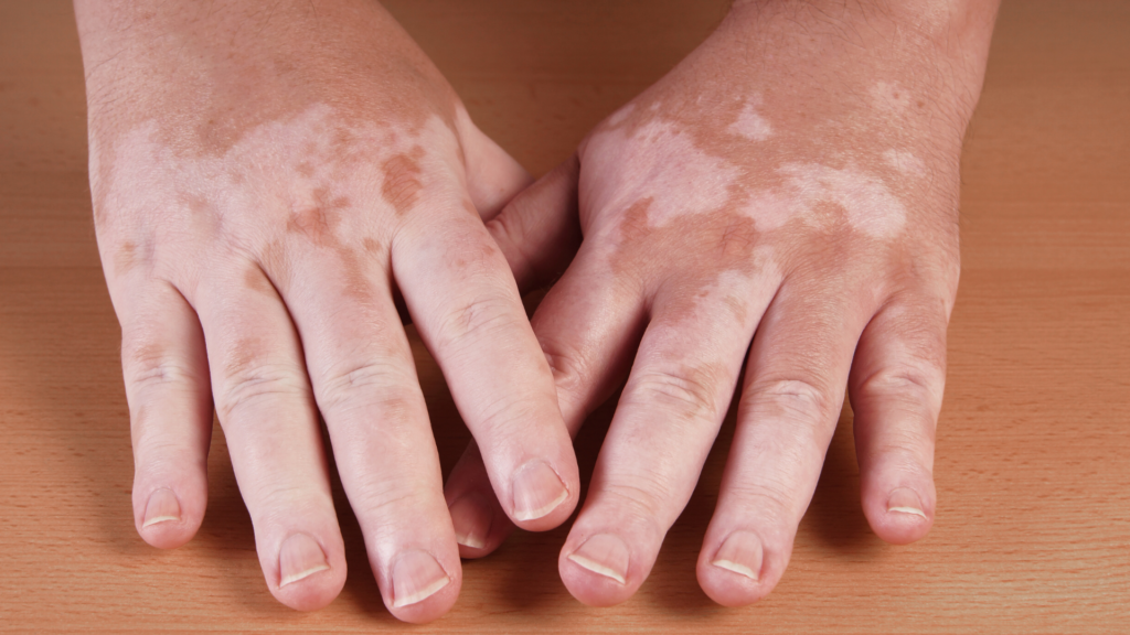 Vitiligo | Dra. Letícia Fachinelli