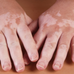 Vitiligo | Dra. Letícia Fachinelli