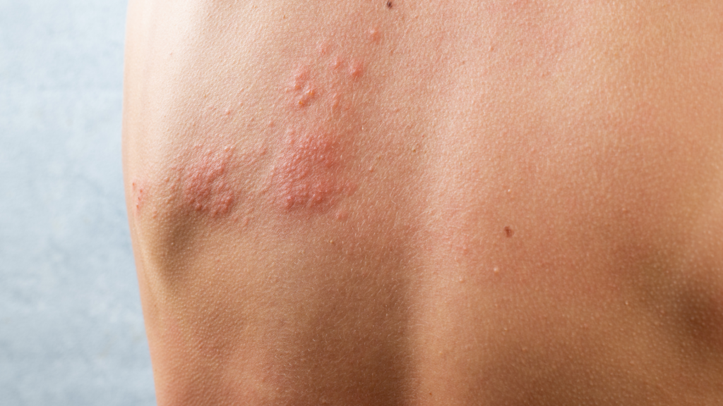 Herpes Zoster | Dra. Letícia Fachinelli