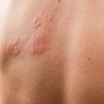 Herpes Zoster | Dra. Letícia Fachinelli