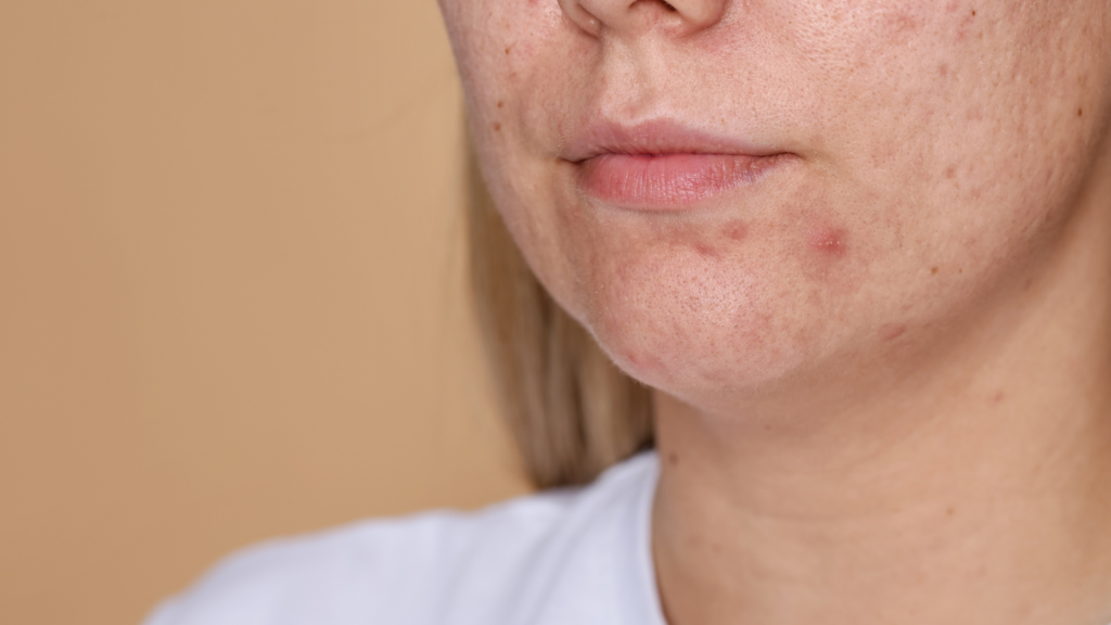 Acne Hormonal | Dra. Letícia Fachinelli