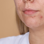 Acne Hormonal | Dra. Letícia Fachinelli