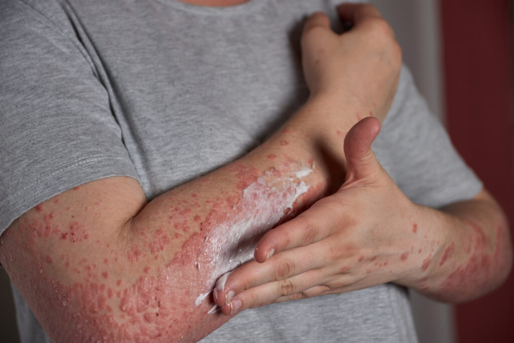 Dermatite Atópica | Dra. Letícia Fachinelli