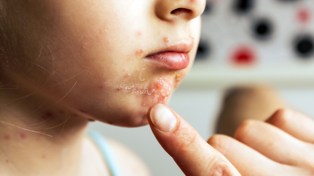 Impetigo | Dra. Letícia Fachinelli
