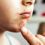 Impetigo | Dra. Letícia Fachinelli