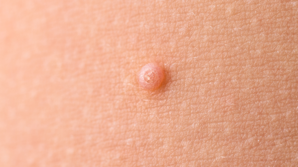 Molusco Contagioso | Dra. Letícia Fachinelli
