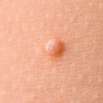 Molusco Contagioso | Dra. Letícia Fachinelli