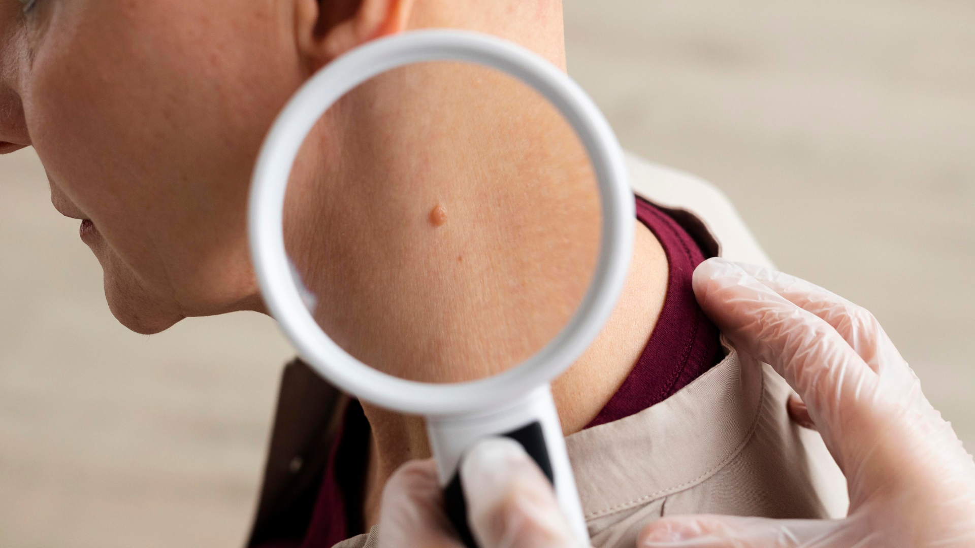 Dermatofibroma | Dra. Letícia Fachinelli