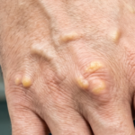 xantomas na pele - tipos, causas e tratamentos dermatológicos